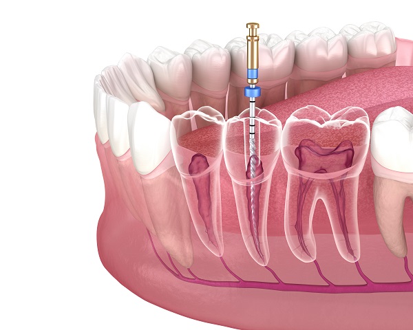 Why Endodontic Therapy Is So Important For An Infected Tooth