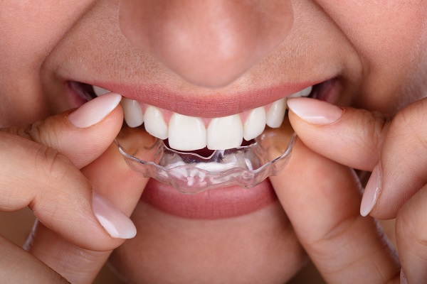What To Discuss At A Dental Consultation About Invisalign